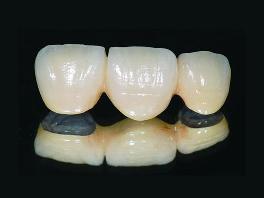 普通烤瓷牙