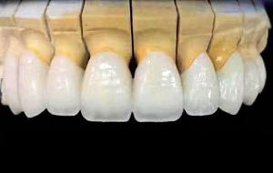 韩瓷（韩系）极光立体瓷