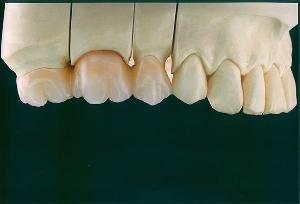 威兰德氧化锆全瓷牙