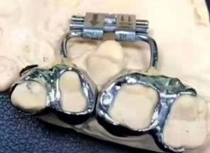 扩弓增隙留五位置